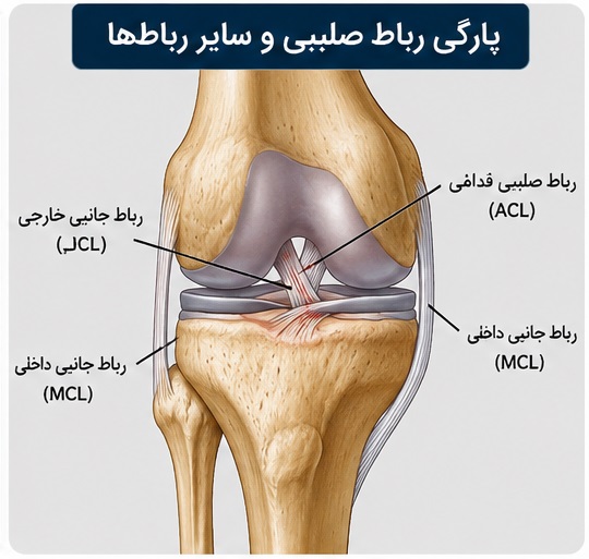 پارگی رباط صلیبی