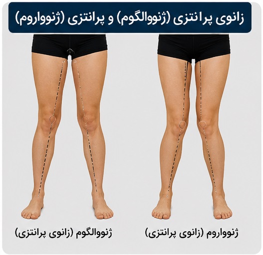 زانو پرانتزی