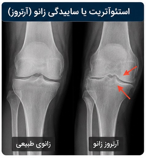 ساییدگی زانو